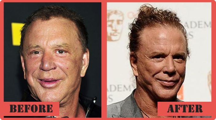 mickey-rourke-Plastic-Surgery-Before-and-After